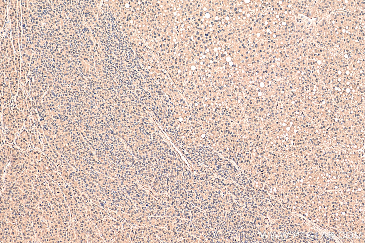 Immunohistochemistry (IHC) staining of human liver cancer tissue using SMAD2 Monoclonal antibody (67343-1-Ig)