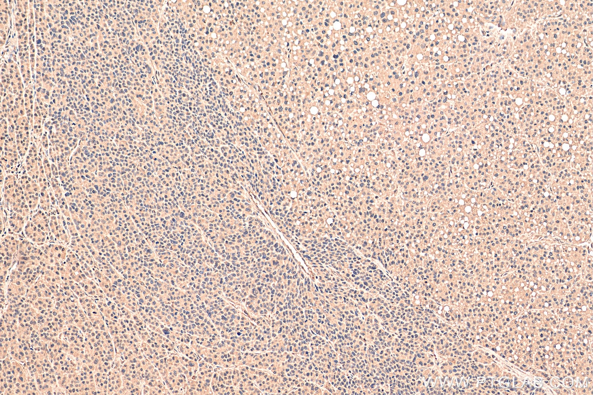 IHC staining of human liver cancer using 67343-1-Ig