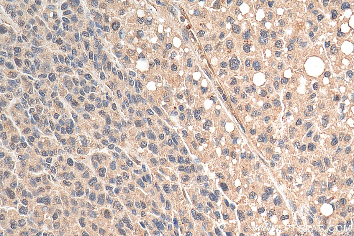 Immunohistochemistry (IHC) staining of human liver cancer tissue using SMAD2 Monoclonal antibody (67343-1-Ig)