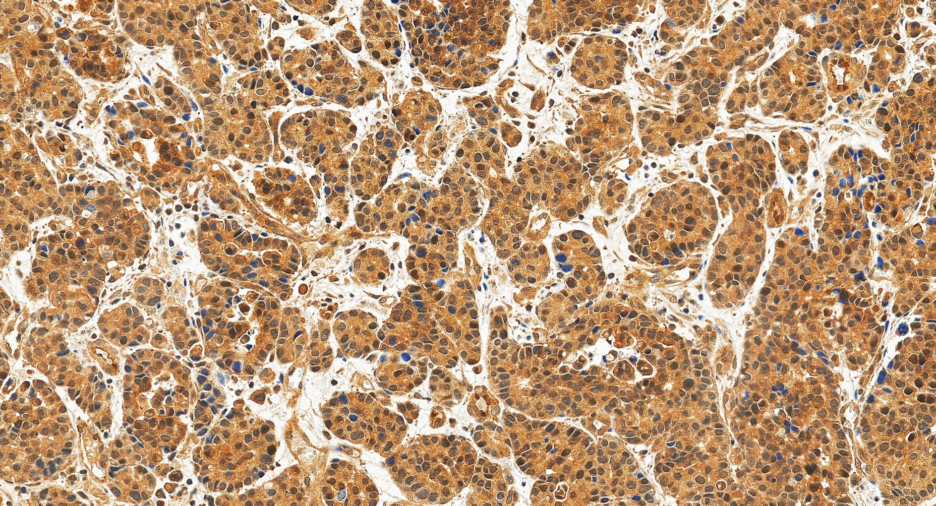 Immunohistochemistry (IHC) staining of human stomach cancer tissue using SMAD2 Recombinant monoclonal antibody (83841-4-RR)
