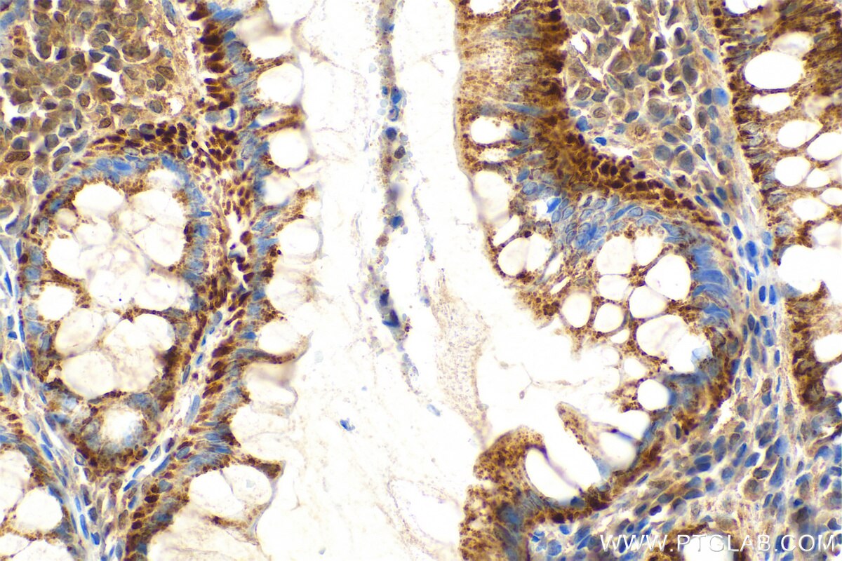 Immunohistochemistry (IHC) staining of human colon cancer tissue using Multi-rAb® SMAD2 Multi-Recombinant antibody (RMX00035)