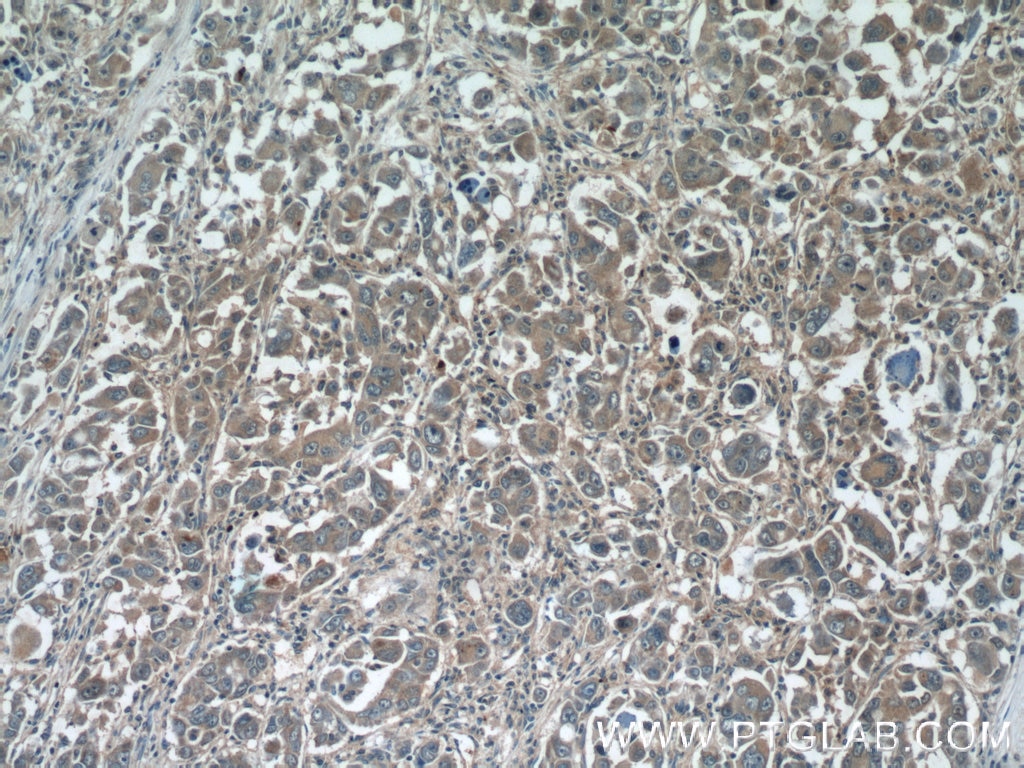 IHC staining of human liver cancer using 25494-1-AP