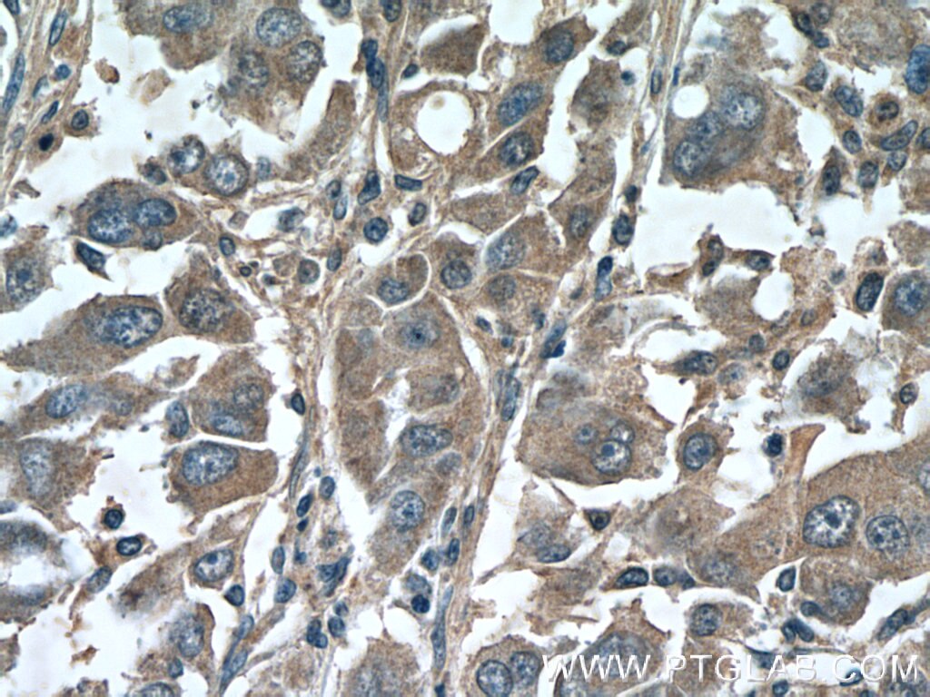 IHC staining of human liver cancer using 25494-1-AP