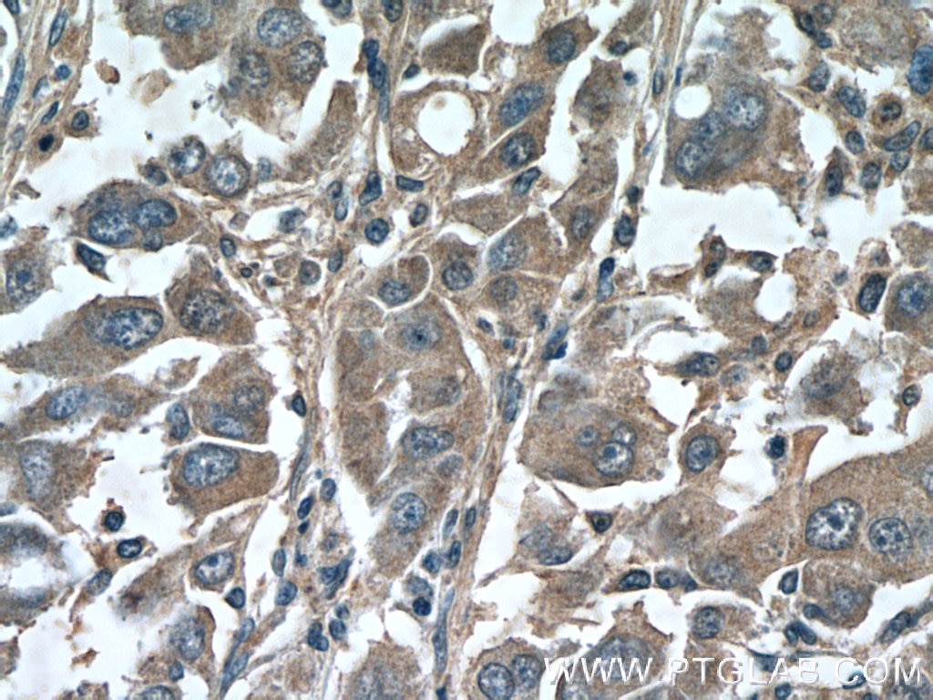 Immunohistochemistry (IHC) staining of human liver cancer tissue using SMAD3 Polyclonal antibody (25494-1-AP)