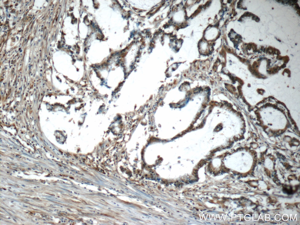 IHC staining of human colon cancer using 25494-1-AP