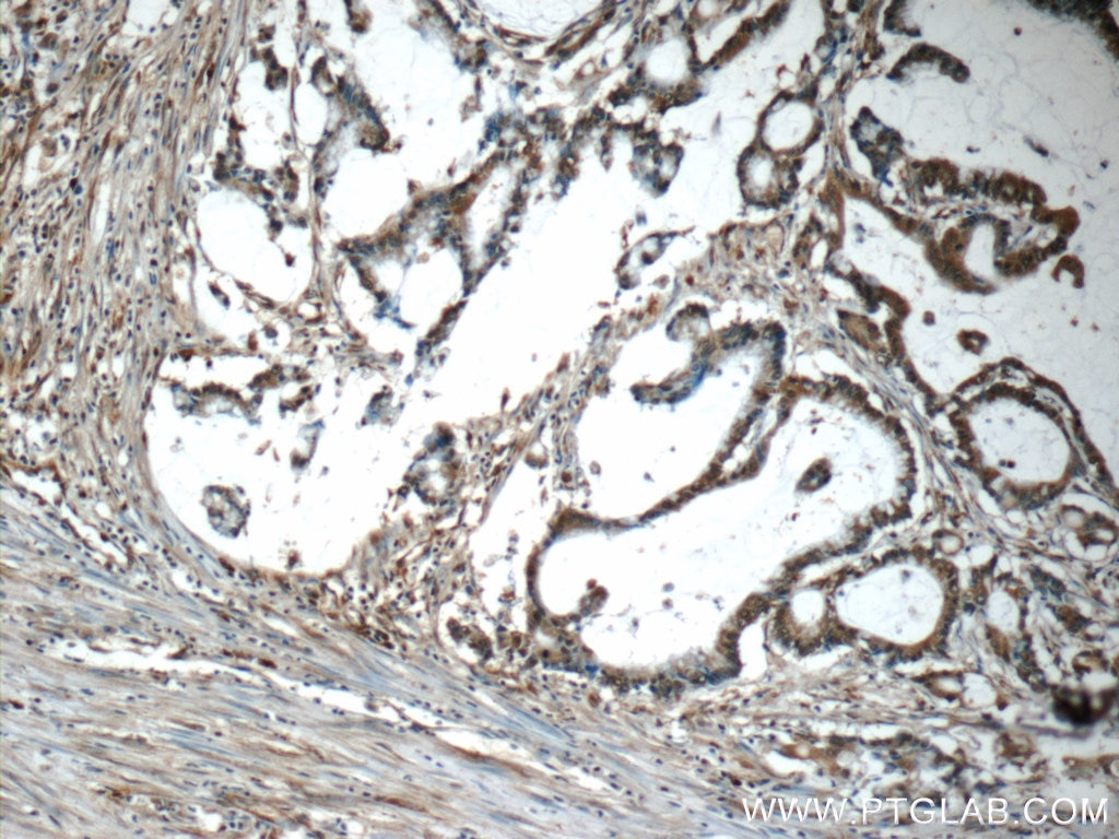 Immunohistochemistry (IHC) staining of human colon cancer tissue using SMAD3 Polyclonal antibody (25494-1-AP)