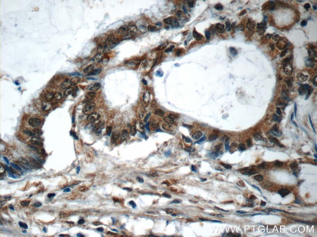 Immunohistochemistry (IHC) staining of human colon cancer tissue using SMAD3 Polyclonal antibody (25494-1-AP)