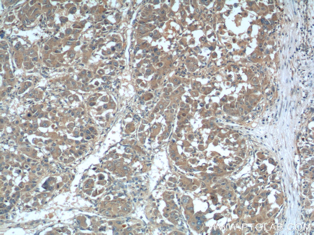 Immunohistochemistry (IHC) staining of human liver cancer tissue using SMAD3 Polyclonal antibody (25494-1-AP)