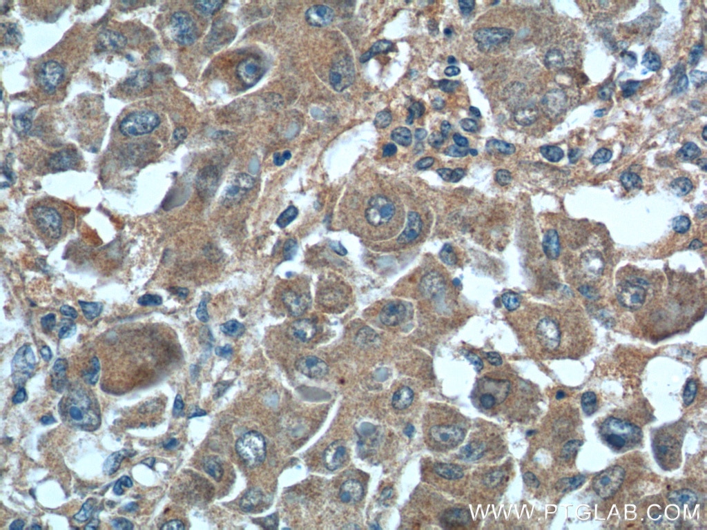 Immunohistochemistry (IHC) staining of human liver cancer tissue using SMAD3 Polyclonal antibody (25494-1-AP)