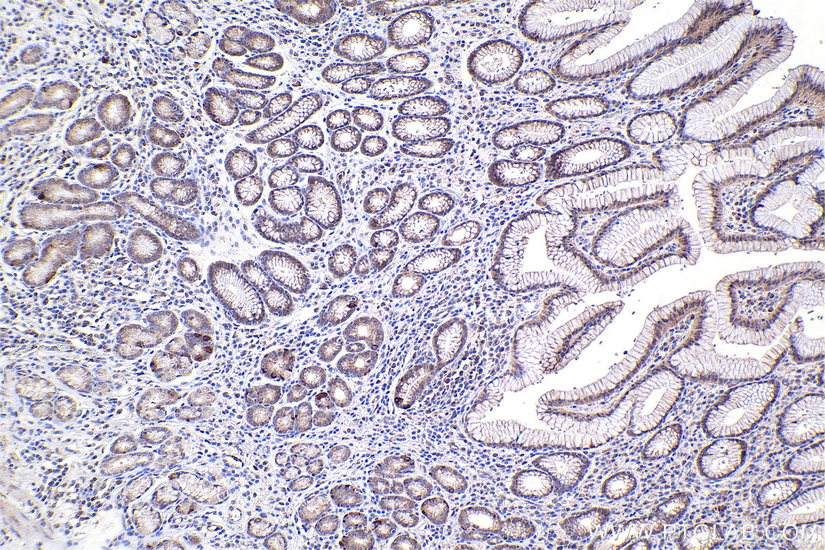 Immunohistochemistry (IHC) staining of human stomach cancer tissue using SMAD3 Polyclonal antibody (30130-1-AP)