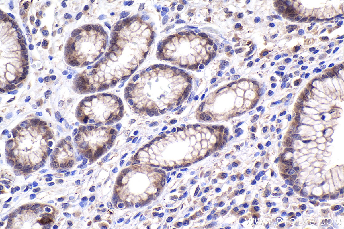 Immunohistochemistry (IHC) staining of human stomach cancer tissue using SMAD3 Polyclonal antibody (30130-1-AP)