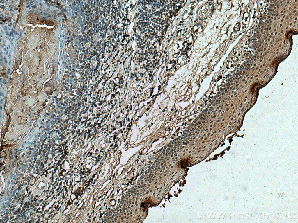 Immunohistochemistry (IHC) staining of human tonsillitis tissue using SMAD4 Polyclonal antibody (10231-1-AP)