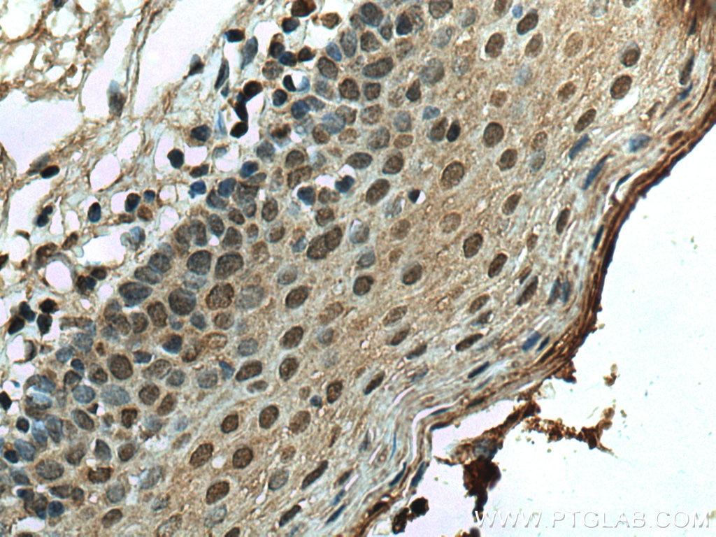 Immunohistochemistry (IHC) staining of human tonsillitis tissue using SMAD4 Polyclonal antibody (10231-1-AP)