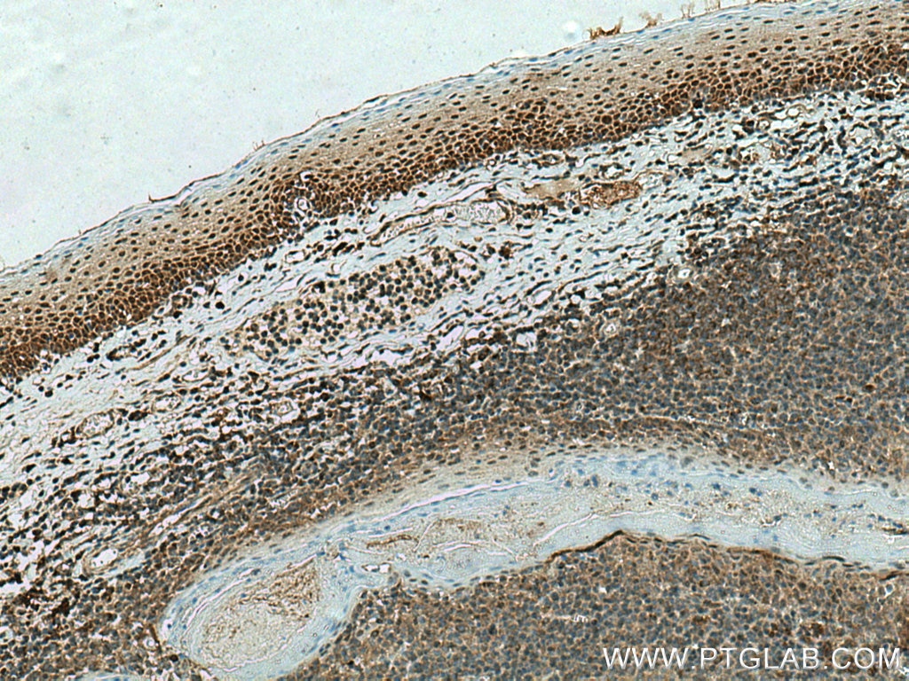 IHC staining of human tonsillitis using 51069-2-AP