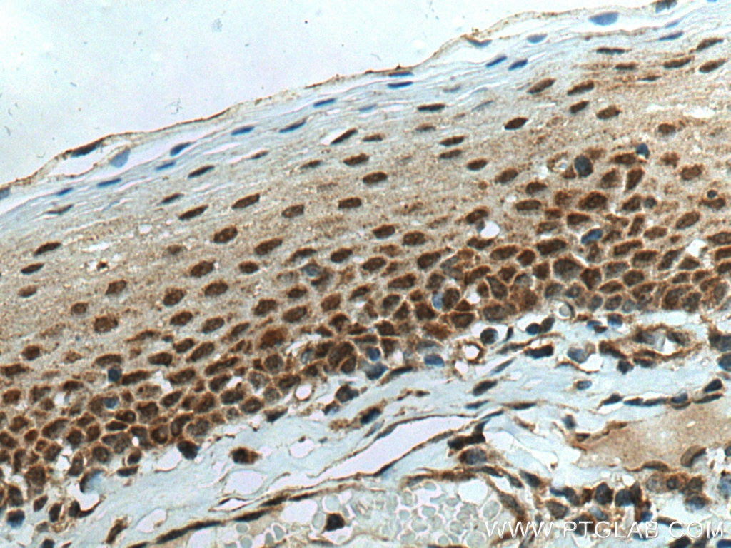 Immunohistochemistry (IHC) staining of human tonsillitis tissue using SMAD4 Polyclonal antibody (51069-2-AP)