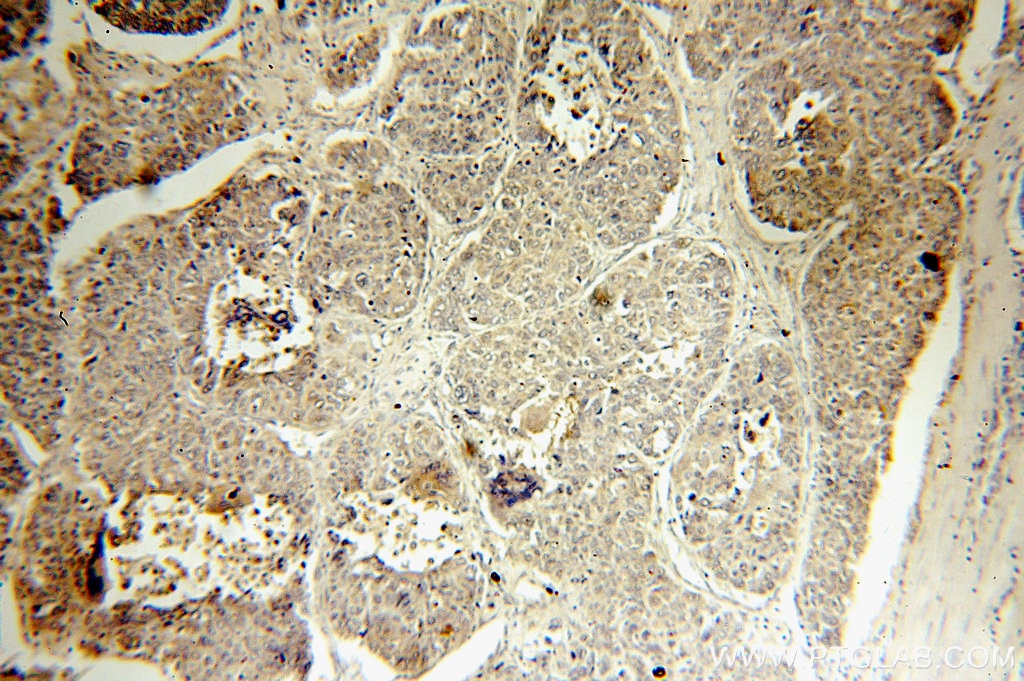 Immunohistochemistry (IHC) staining of human liver cancer tissue using SMAD4 Polyclonal antibody (51069-2-AP)