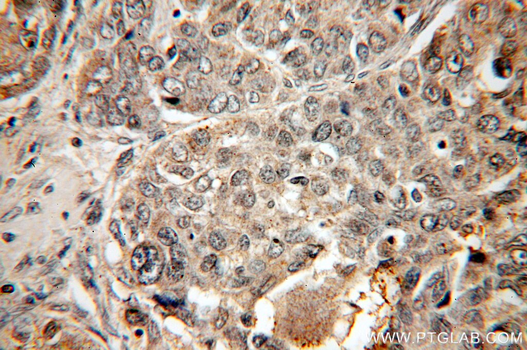 Immunohistochemistry (IHC) staining of human liver cancer tissue using SMAD4 Polyclonal antibody (51069-2-AP)