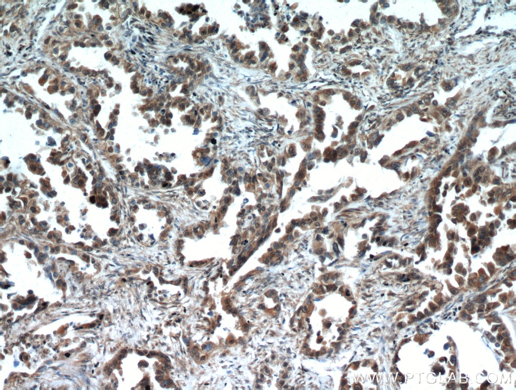 IHC staining of human lung cancer using 51069-2-AP