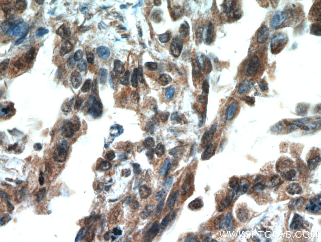 Immunohistochemistry (IHC) staining of human lung cancer tissue using SMAD4 Polyclonal antibody (51069-2-AP)
