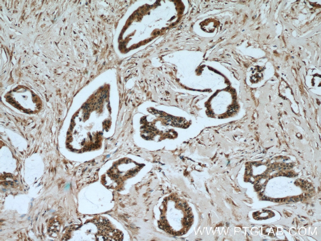 Immunohistochemistry (IHC) staining of human breast cancer tissue using SMAD4 Monoclonal antibody (60182-1-Ig)
