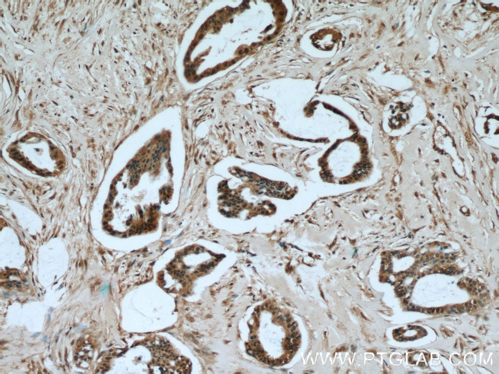 IHC staining of human breast cancer using 60182-1-Ig