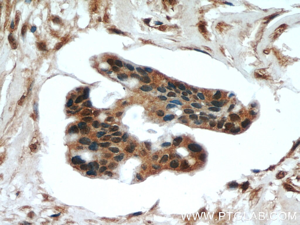 Immunohistochemistry (IHC) staining of human breast cancer tissue using SMAD4 Monoclonal antibody (60182-1-Ig)