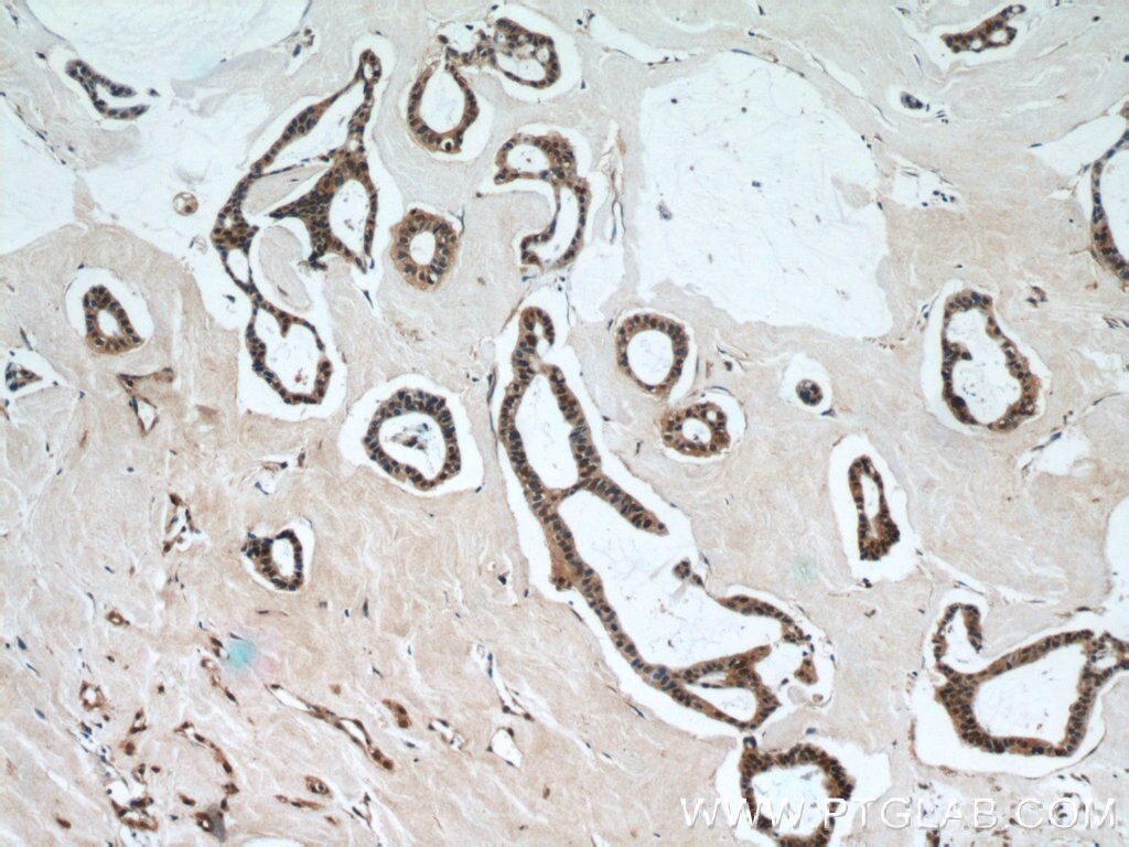 Immunohistochemistry (IHC) staining of human breast cancer tissue using SMAD4 Monoclonal antibody (60182-1-Ig)