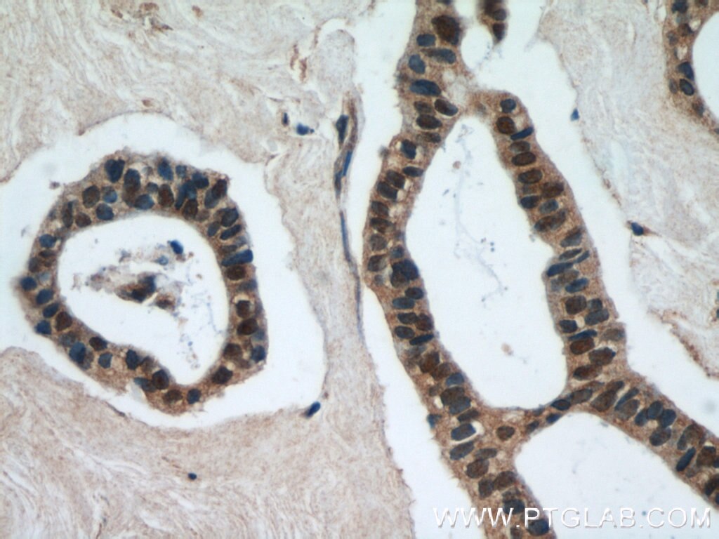 Immunohistochemistry (IHC) staining of human breast cancer tissue using SMAD4 Monoclonal antibody (60182-1-Ig)