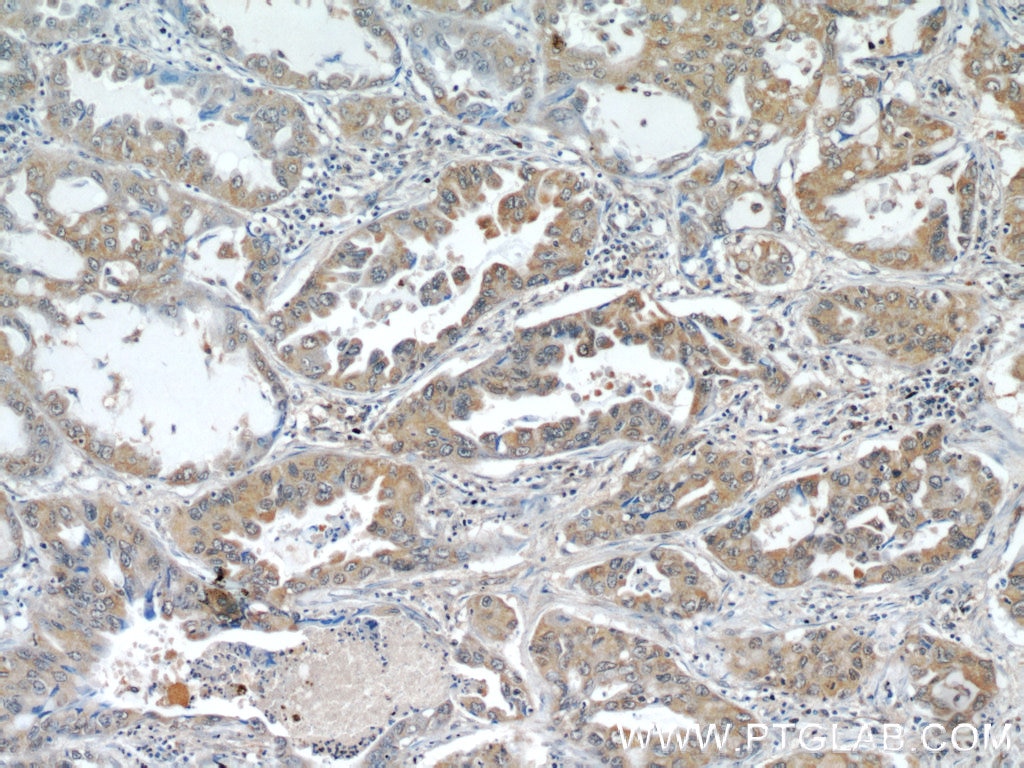 Immunohistochemistry (IHC) staining of human lung cancer tissue using SMAD4 Monoclonal antibody (60182-1-Ig)