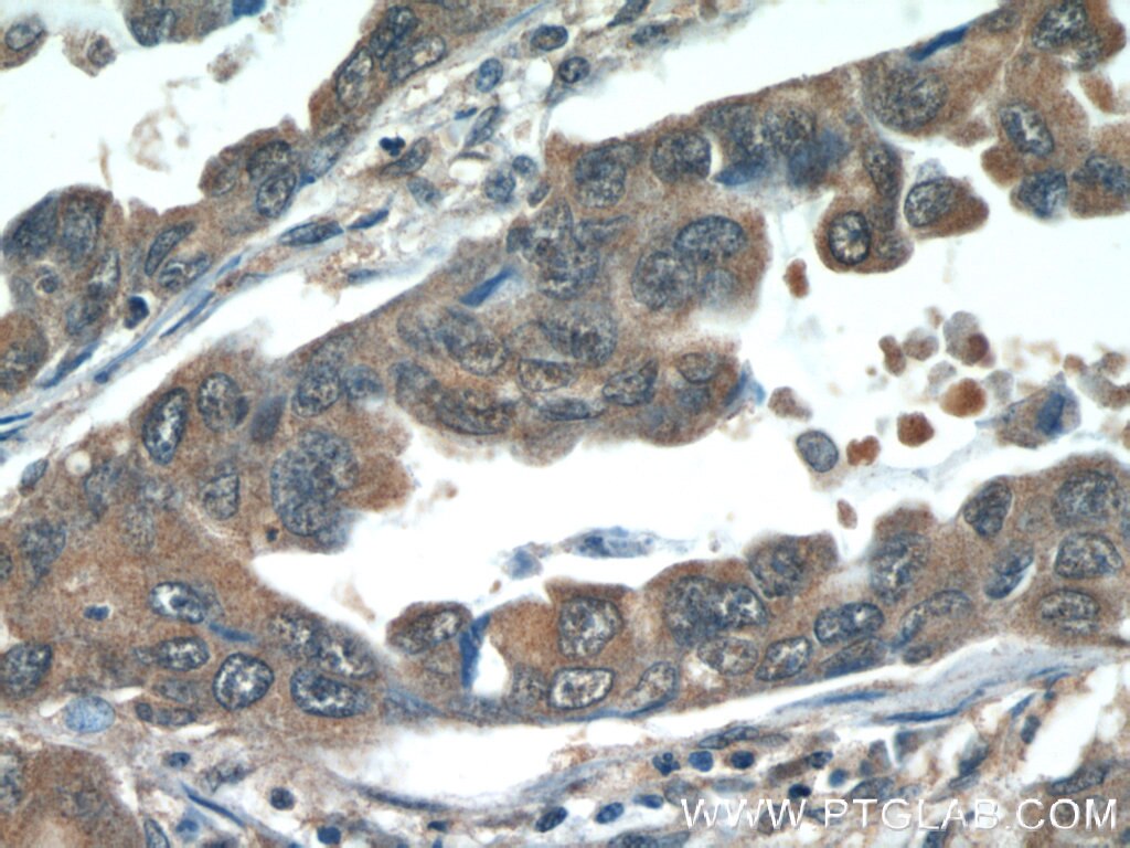 Immunohistochemistry (IHC) staining of human lung cancer tissue using SMAD4 Monoclonal antibody (60182-1-Ig)