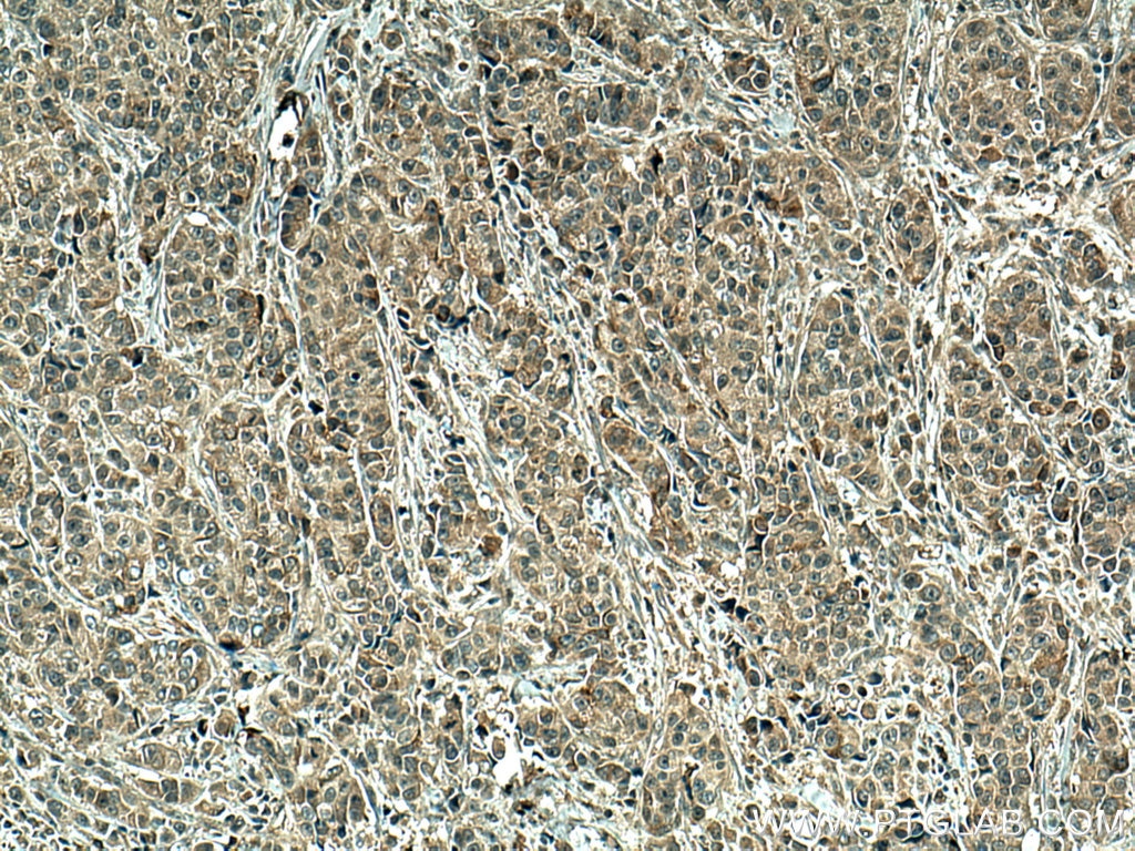Immunohistochemistry (IHC) staining of human breast cancer tissue using SMAD5 Monoclonal antibody (67052-1-Ig)