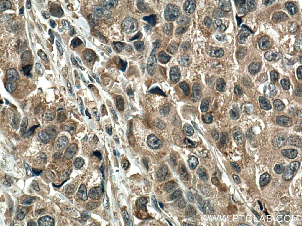 Immunohistochemistry (IHC) staining of human breast cancer tissue using SMAD5 Monoclonal antibody (67052-1-Ig)