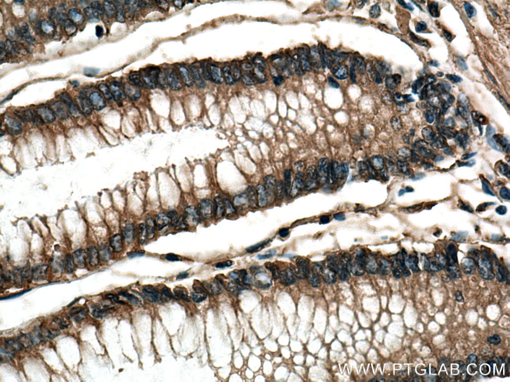 Immunohistochemistry (IHC) staining of human colon cancer tissue using SMAD5 Monoclonal antibody (67052-1-Ig)