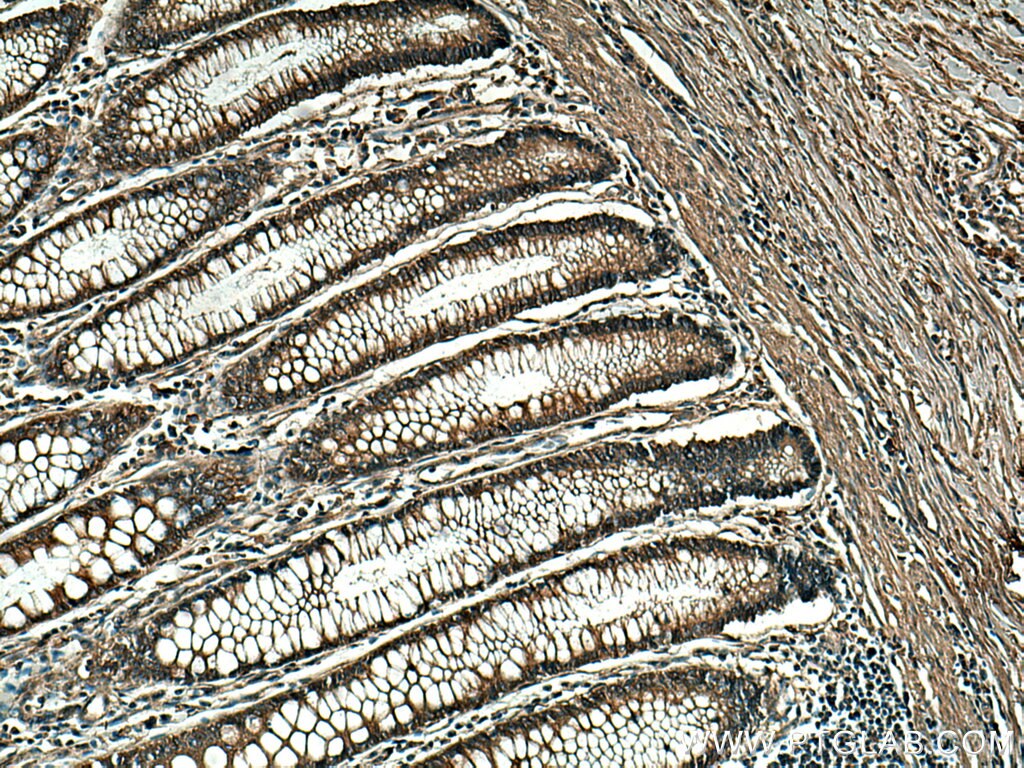 Immunohistochemistry (IHC) staining of human colon cancer tissue using SMAD5 Monoclonal antibody (67052-1-Ig)