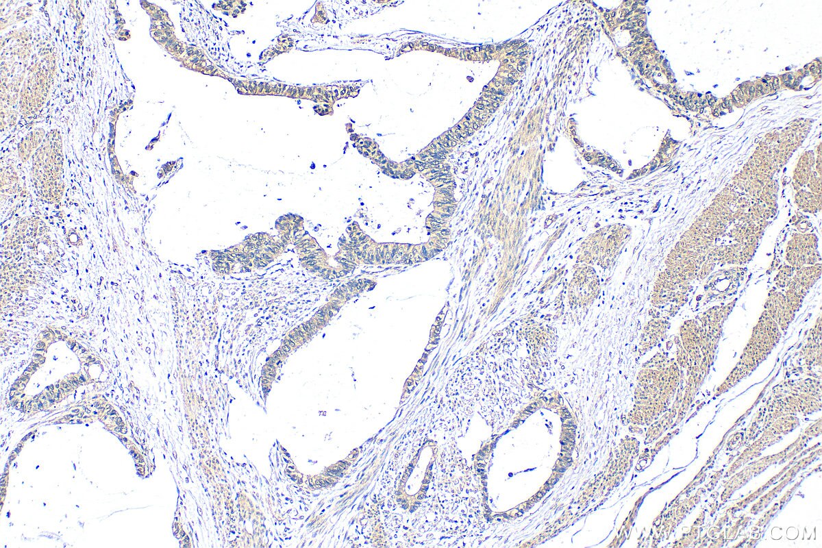 IHC staining of human urothelial carcinoma using 80964-5-RR Immunohistochemistry (IHC) staining of human urothelial carcinoma tissue using SMAD7 Recombinant monoclonal antibody (80964-5-RR)