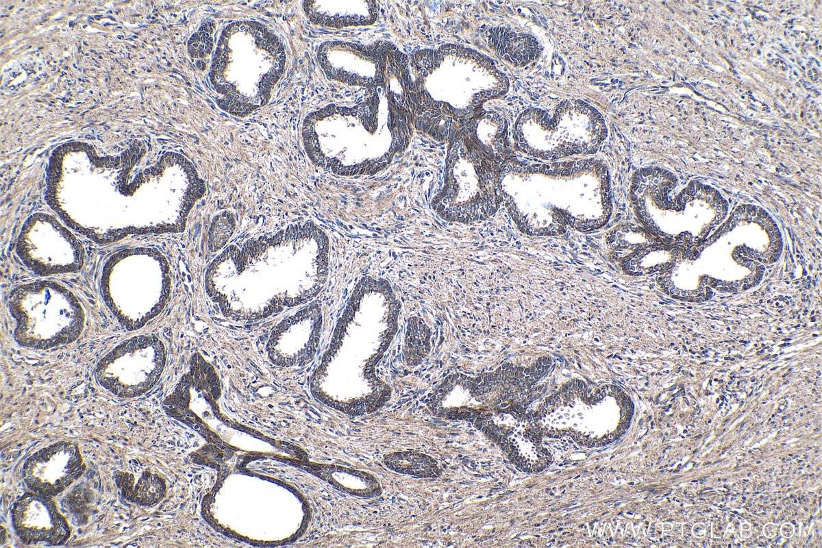 Immunohistochemistry (IHC) staining of human prostate cancer tissue using SMAD9 Polyclonal antibody (16397-1-AP)