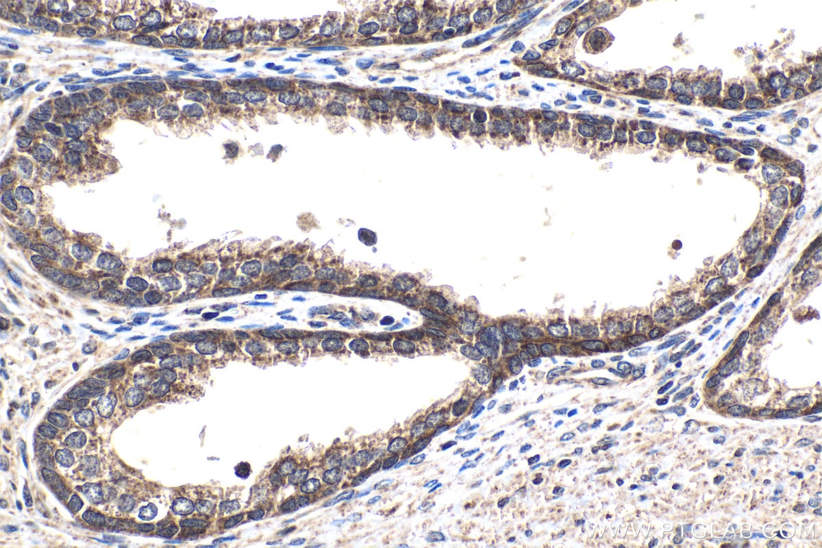 Immunohistochemistry (IHC) staining of human prostate cancer tissue using SMAD9 Polyclonal antibody (16397-1-AP)