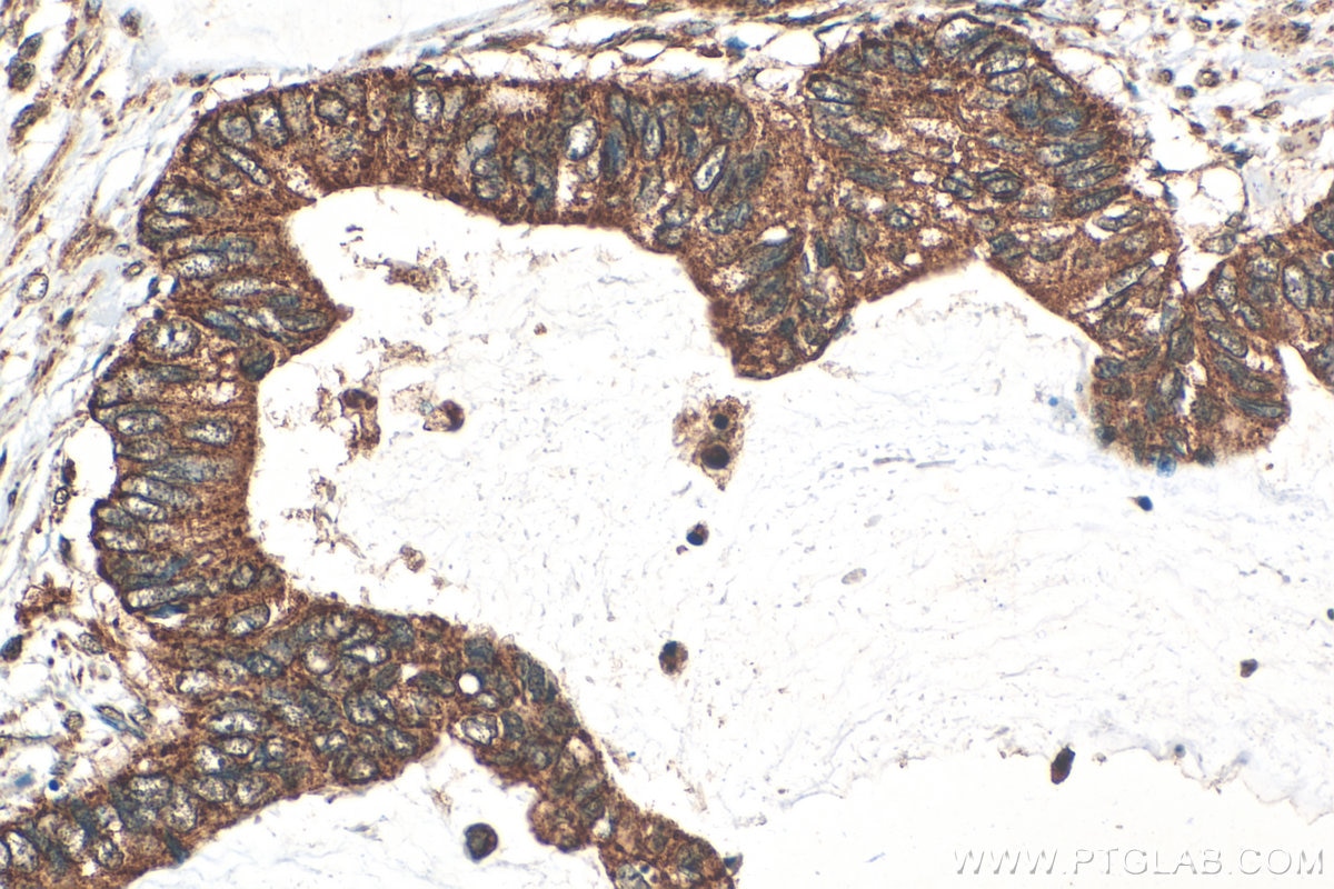 Immunohistochemistry (IHC) staining of human urothelial carcinoma tissue using SMAD9 Polyclonal antibody (16397-1-AP)
