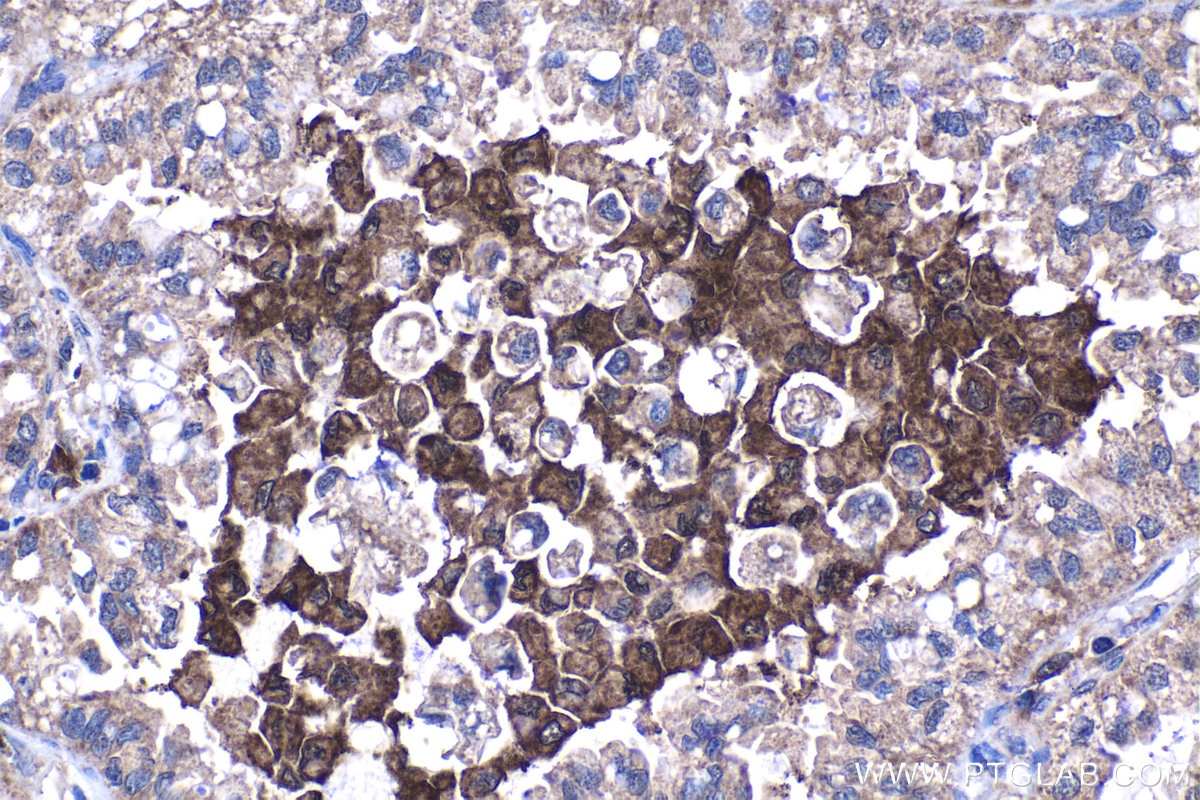 Immunohistochemistry (IHC) staining of human lung cancer tissue using SMAP2 Polyclonal antibody (16597-1-AP)