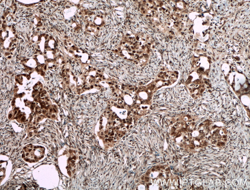 IHC staining of human ovary tumor using 26613-1-AP