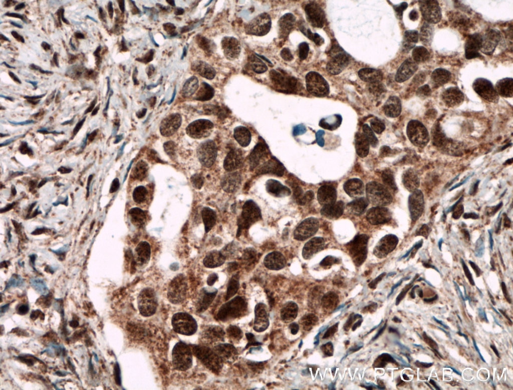 Immunohistochemistry (IHC) staining of human ovary tumor tissue using SMARCA2-Specific Polyclonal antibody (26613-1-AP)