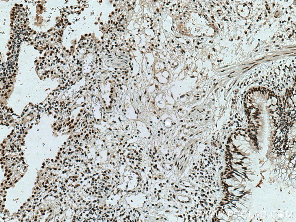 Immunohistochemistry (IHC) staining of human lung cancer tissue using SMARCA4/BRG1 Polyclonal antibody (21634-1-AP)