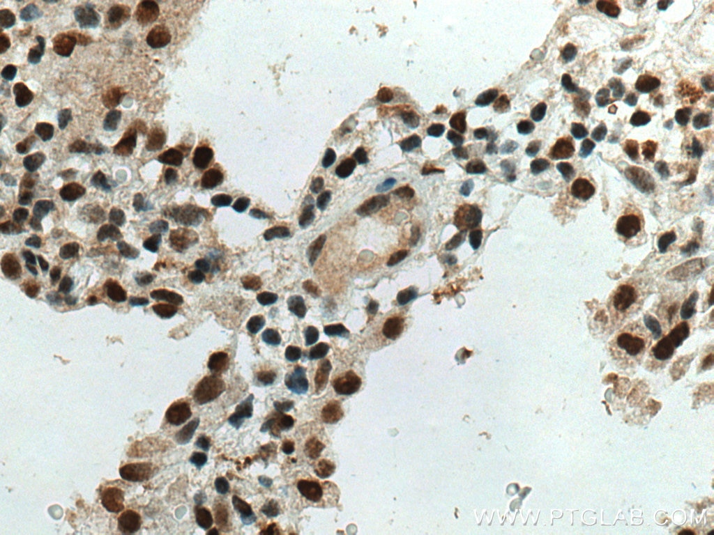 Immunohistochemistry (IHC) staining of human lung cancer tissue using SMARCA4/BRG1 Polyclonal antibody (21634-1-AP)