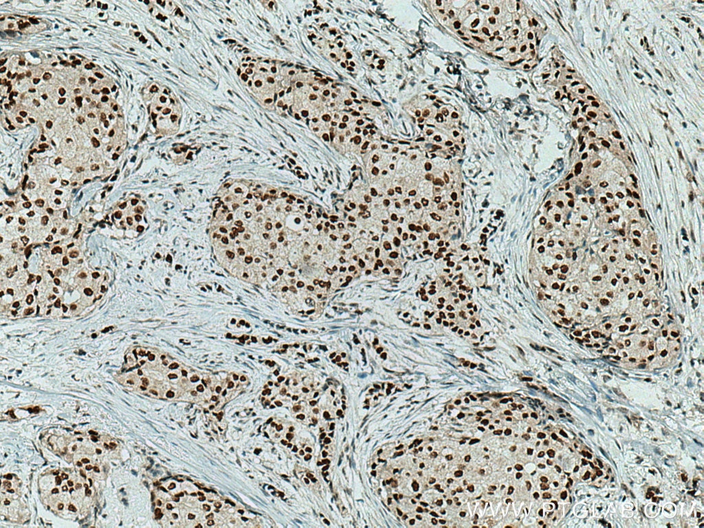 Immunohistochemistry (IHC) staining of human breast cancer tissue using SMARCA4/BRG1 Polyclonal antibody (21634-1-AP)
