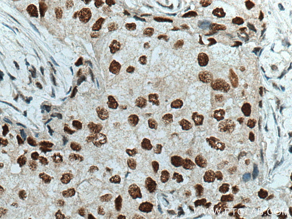 IHC staining of human breast cancer using 21634-1-AP