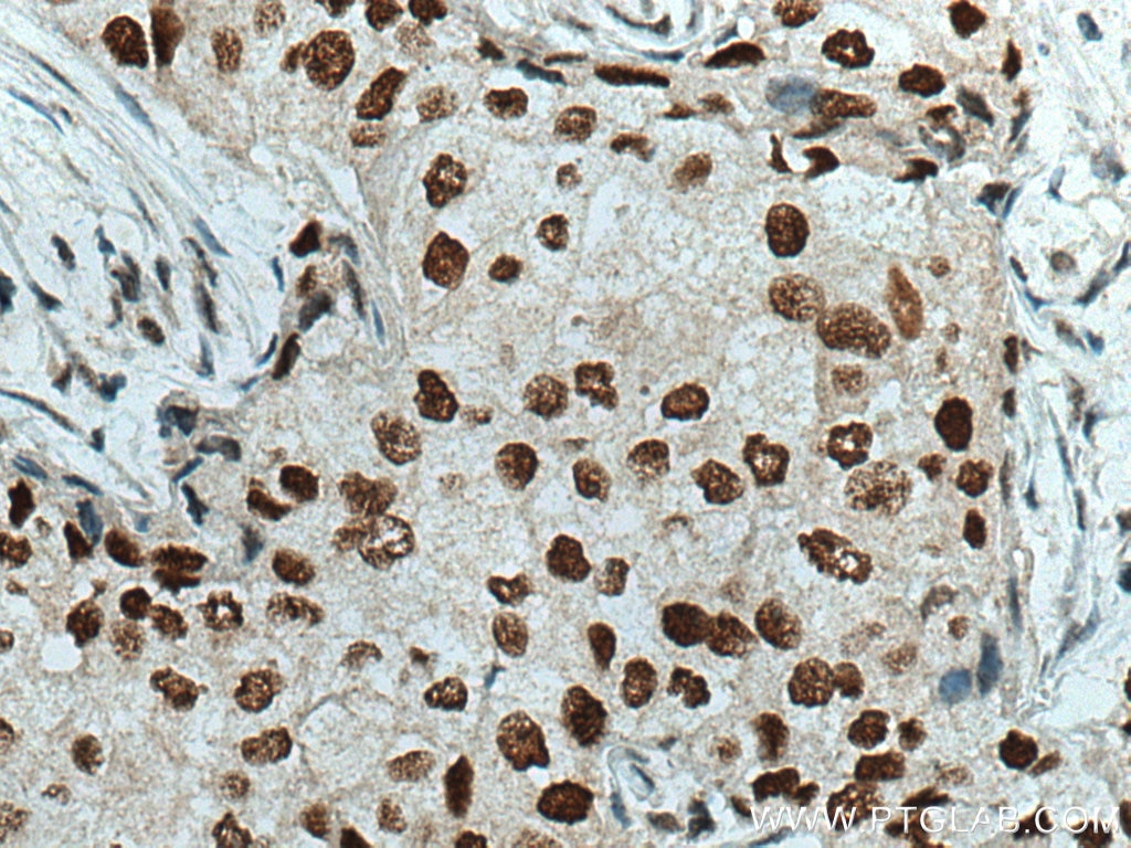 Immunohistochemistry (IHC) staining of human breast cancer tissue using SMARCA4/BRG1 Polyclonal antibody (21634-1-AP)