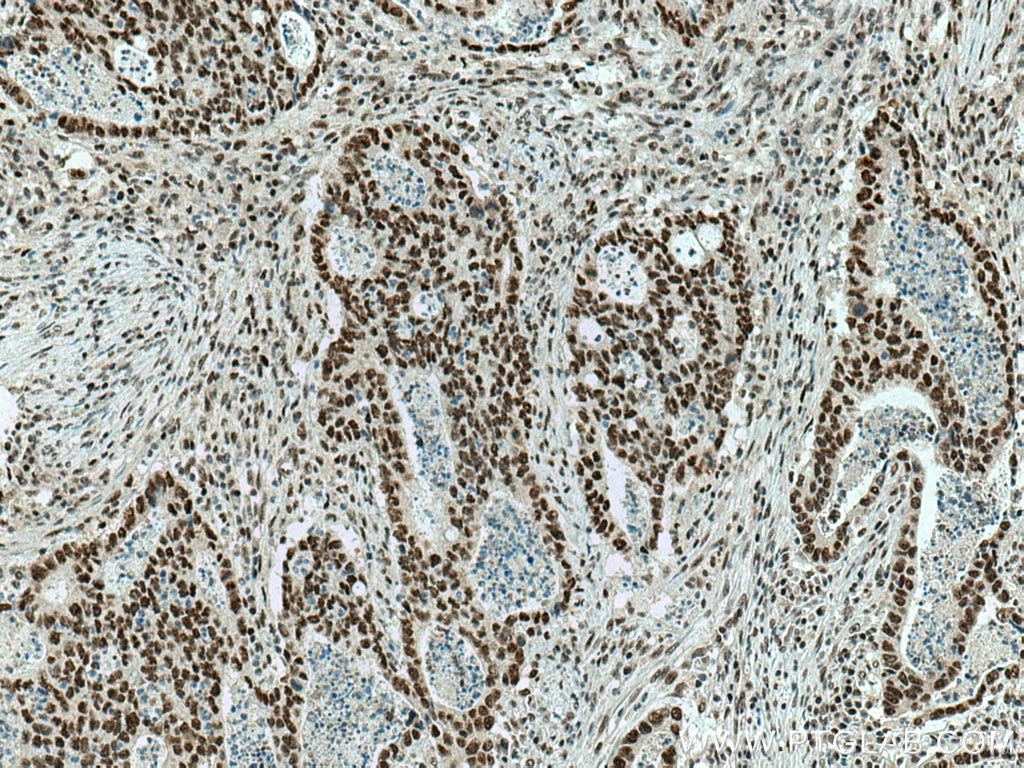 IHC staining of human colon cancer using 21634-1-AP
