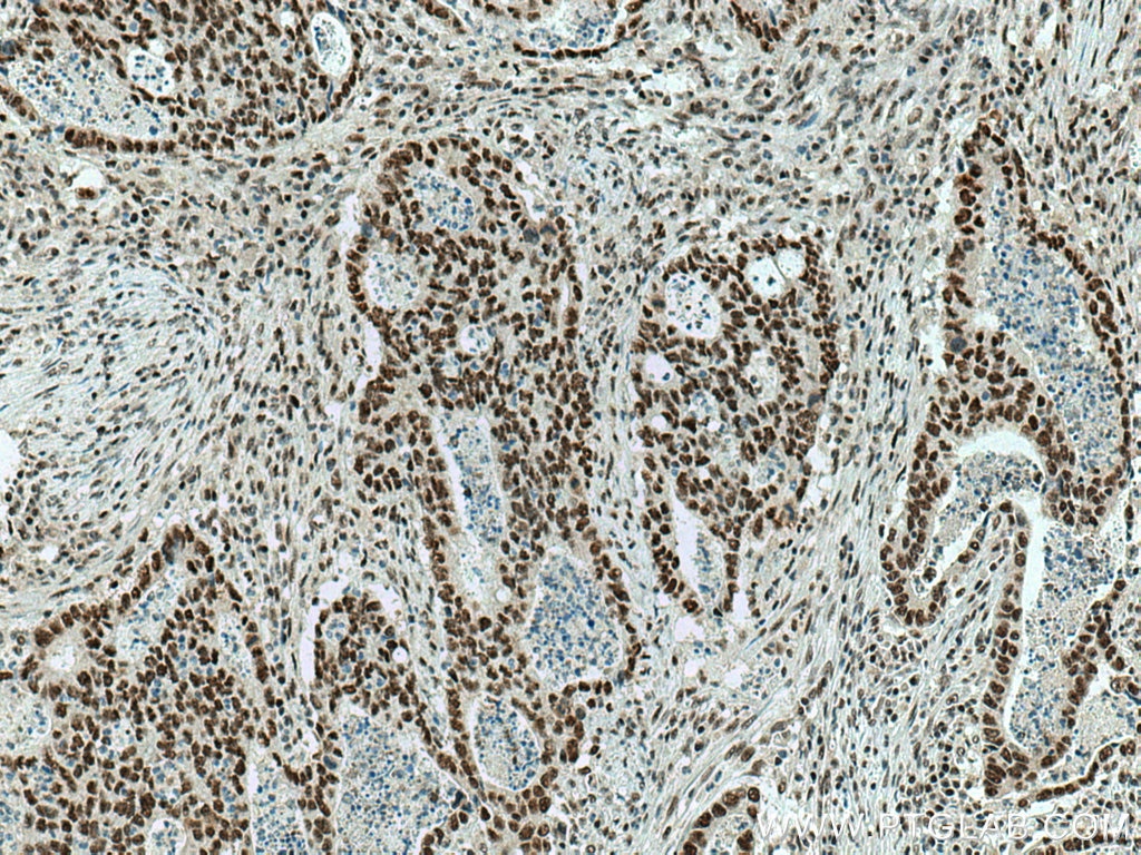 Immunohistochemistry (IHC) staining of human colon cancer tissue using SMARCA4/BRG1 Polyclonal antibody (21634-1-AP)