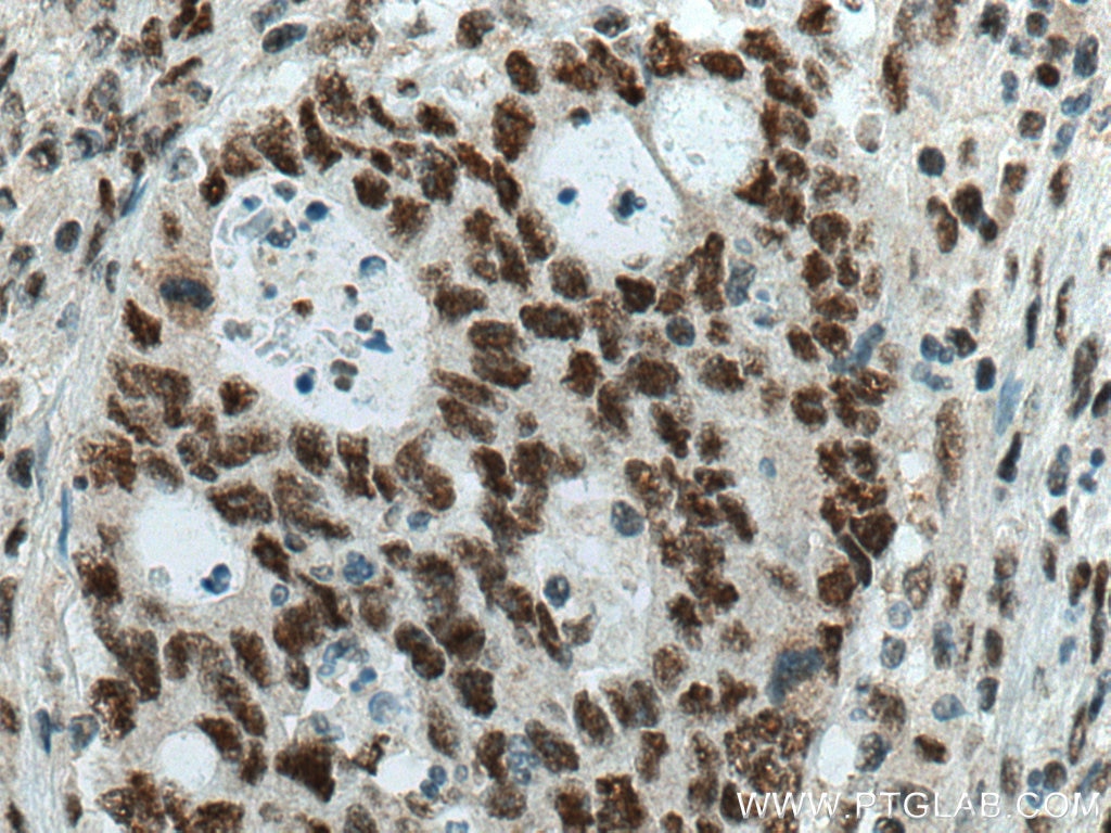 Immunohistochemistry (IHC) staining of human colon cancer tissue using SMARCA4/BRG1 Polyclonal antibody (21634-1-AP)