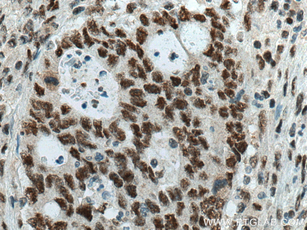 IHC staining of human colon cancer using 21634-1-AP